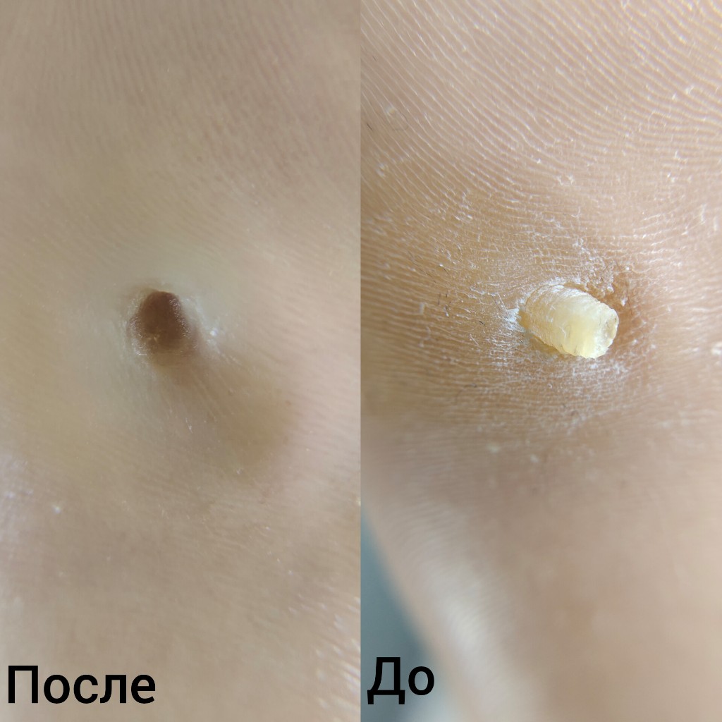 Стержневая мозоль